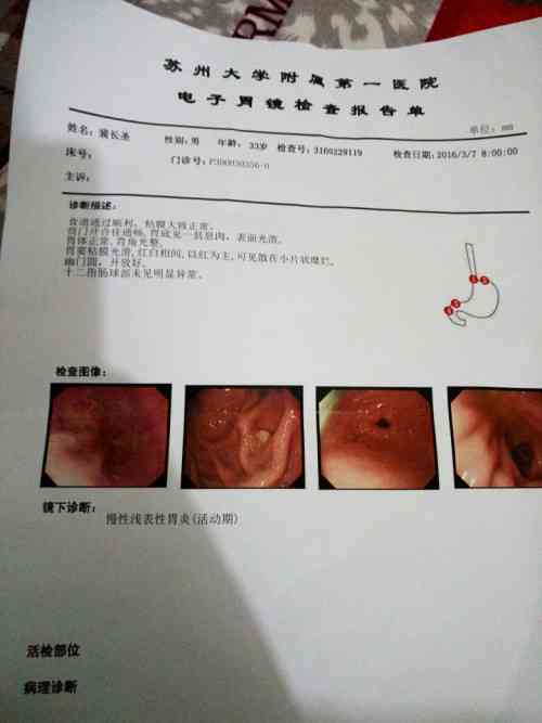 如何解读胃镜病理报告单及其结果