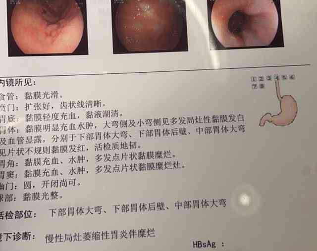 详尽解读：如何全面分析胃镜检查与活检病理报告，掌握病情要点