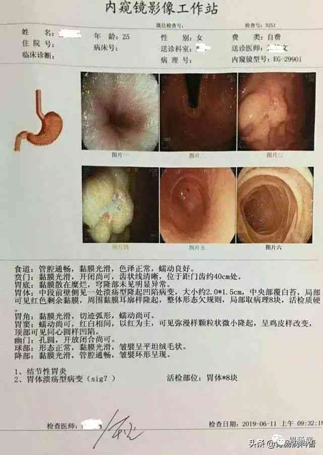 详尽解读：如何全面分析胃镜检查与活检病理报告，掌握病情要点