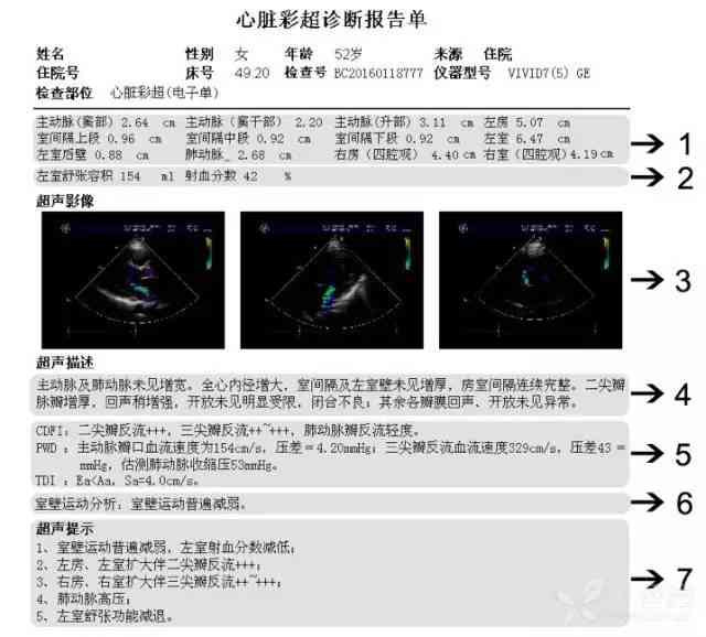 心脏超声报告单怎么看：全面解读结果与要点精髓