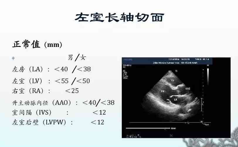 心脏超声报告单解读-心脏超声报告单解读视频