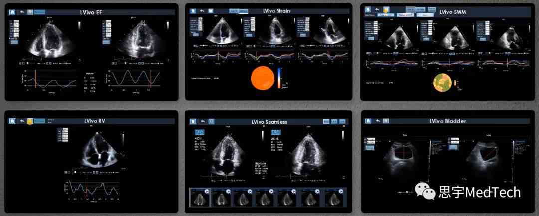 心脏超声报告单AI