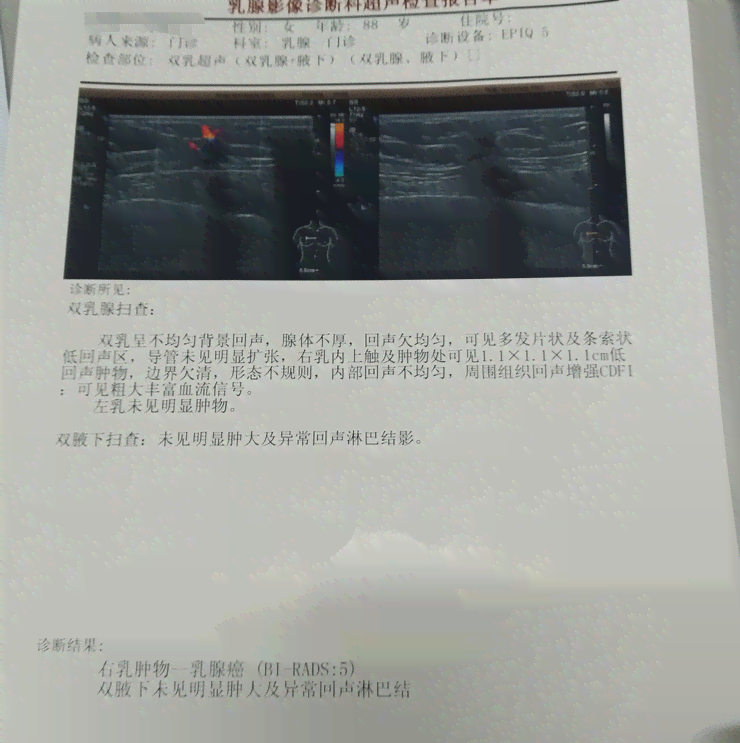 '乳腺癌病理报告中的AR是什么意思？—医生解读健网专业说法'