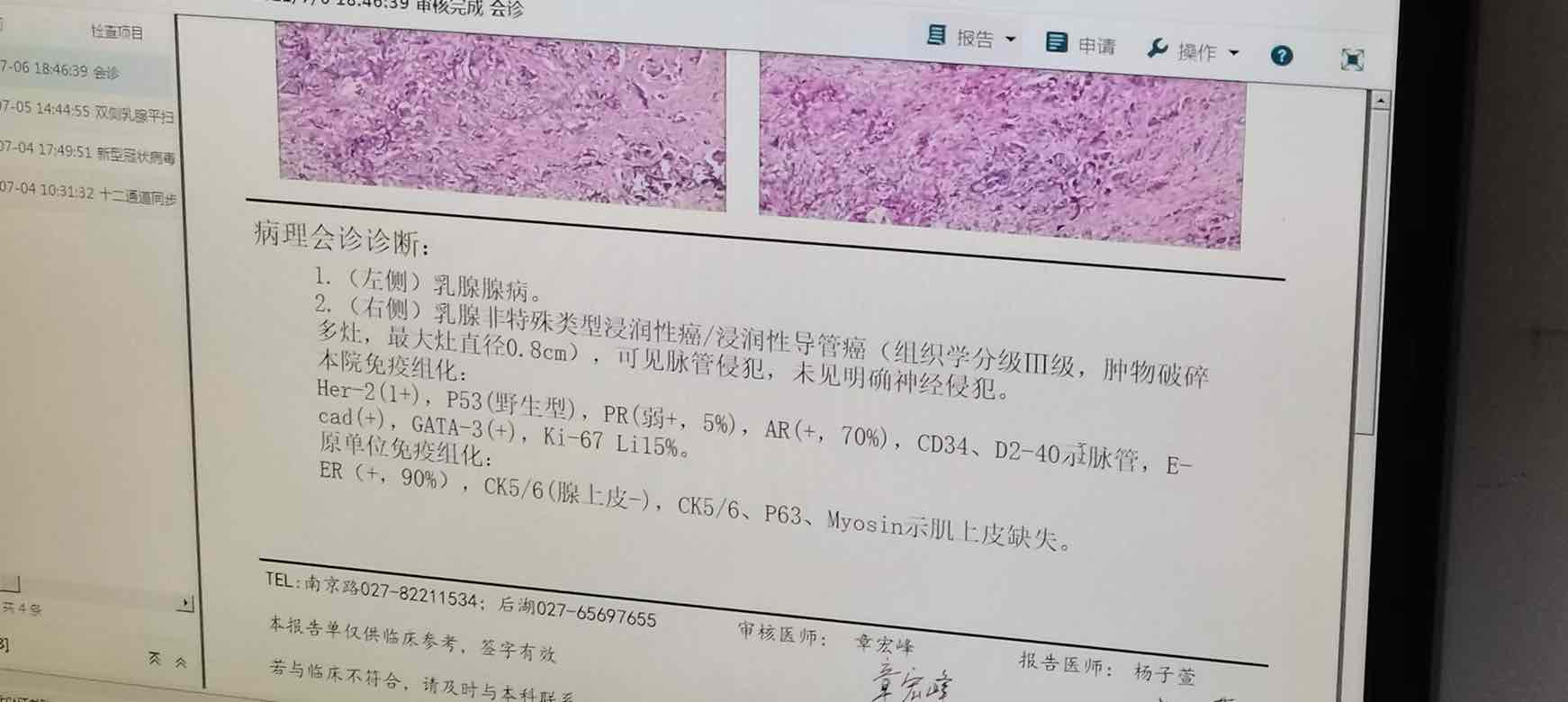 乳腺癌病理报告书的ai是什么