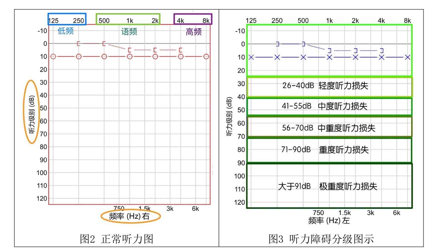 听力测试报告单中AI是什么意思