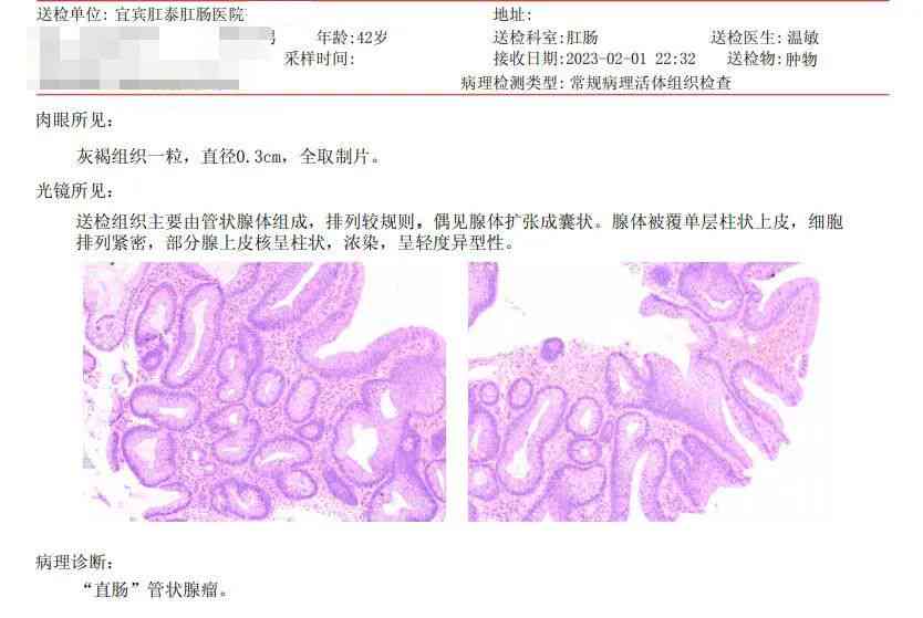 病理报告AI16：如何判断良性恶性，详解管状腺瘤、子宫内膜增生与肠息肉报告