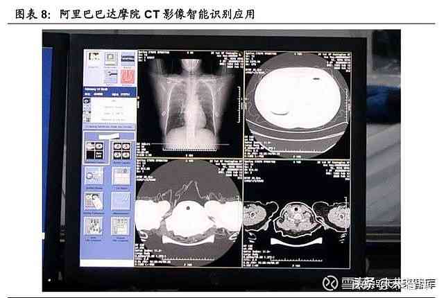 ct报告出现AI异常征象诊断分析及临床意义解读