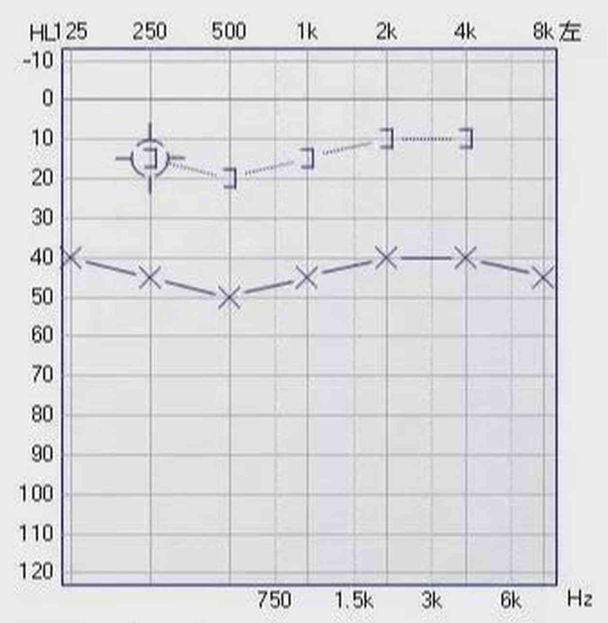 听力检测报告单ai代表什么