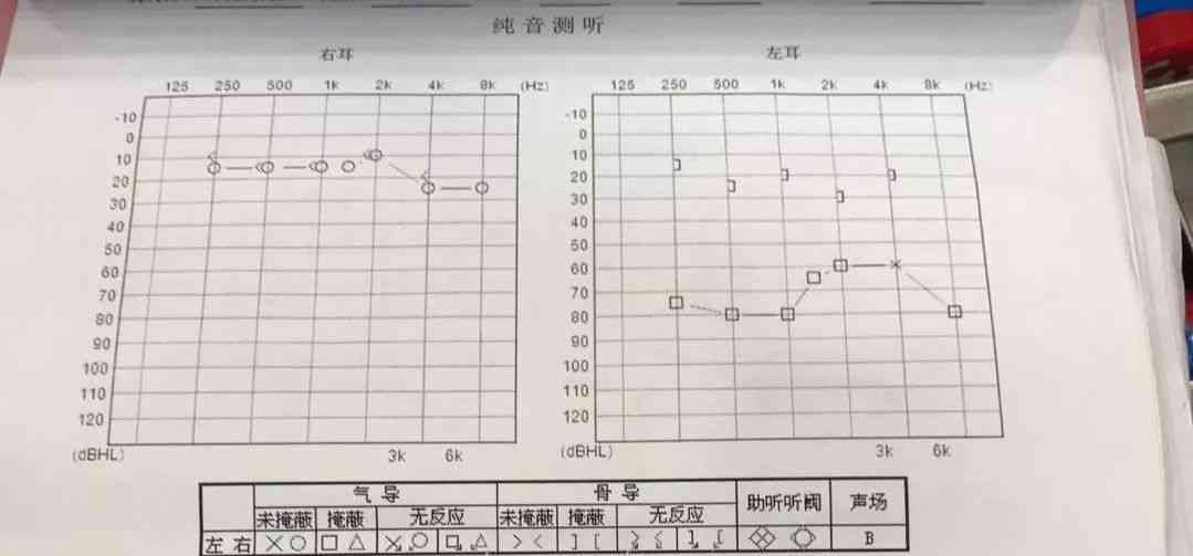 纯音测听报告ai是什么意思