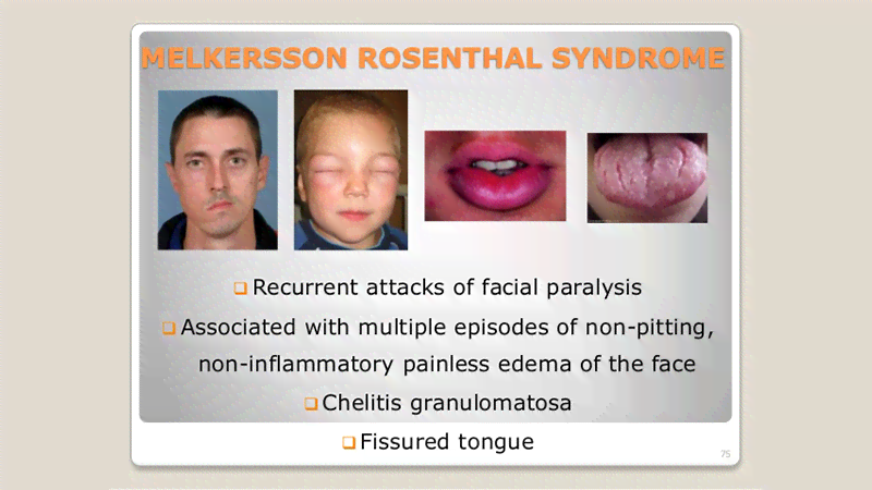 尼克综合征：症状、诊断与治疗全解析
