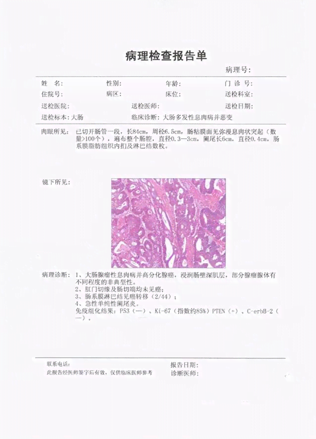 病理检查辅助系统：一键生成癌症肿瘤检查报告单