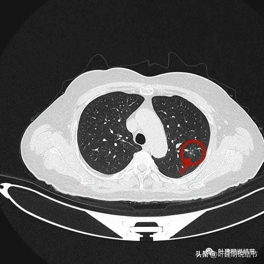 ai识别肺结节如果错误还会报告吗：探讨AI检测准确性及错误报告的可能性