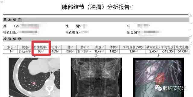 ai识别肺结节如果错误还会报告吗