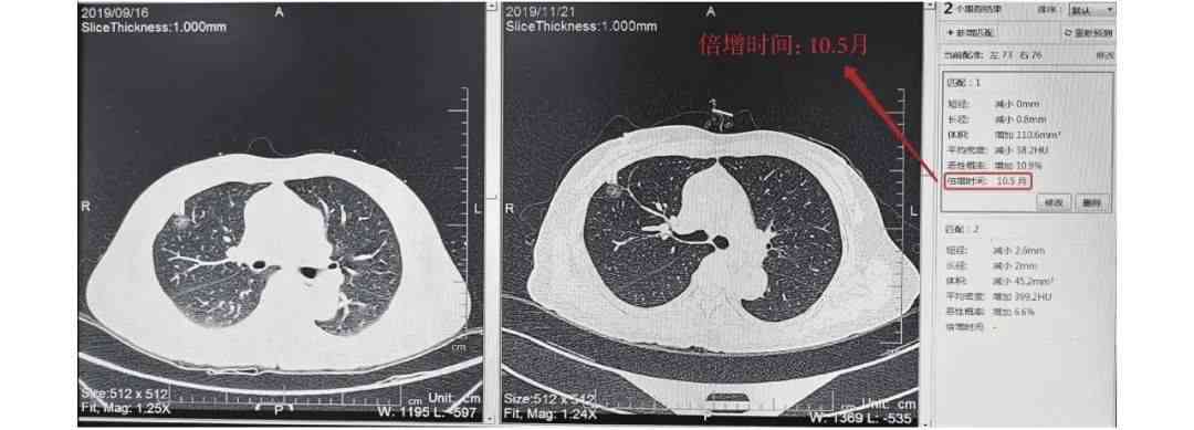 ai识别低危肺部结节报告没有报告，患者结节单遗漏未通报