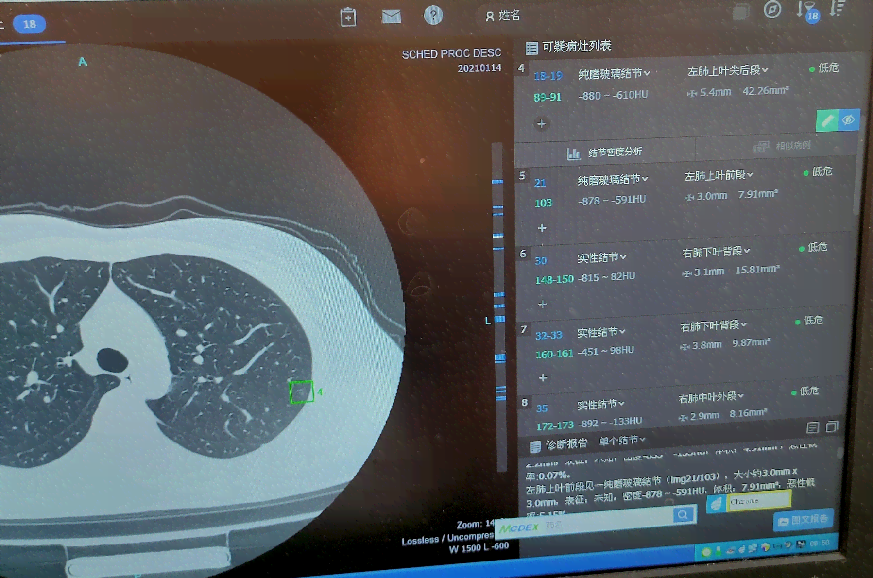 ai识别低危肺部结节报告没有报告，患者结节单遗漏未通报