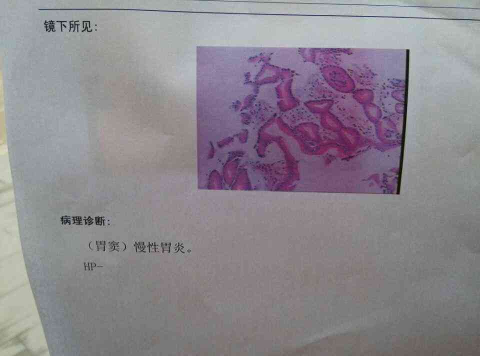 胃镜显示al什么意思：胃镜显示llaa1含义解析