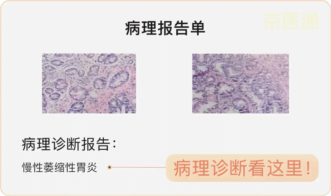 胃镜报告中AB号的含义及常见相关问题解析