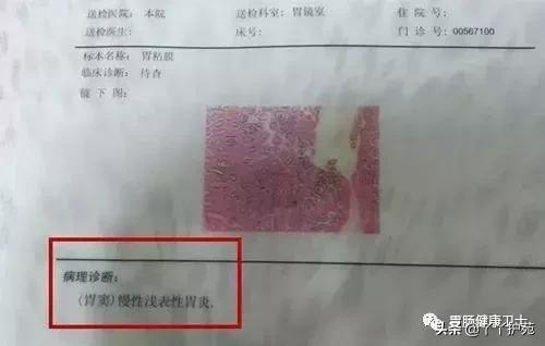 胃镜检查报告ci是什么意思：胃镜结果C1或C-1的含义及原因解析