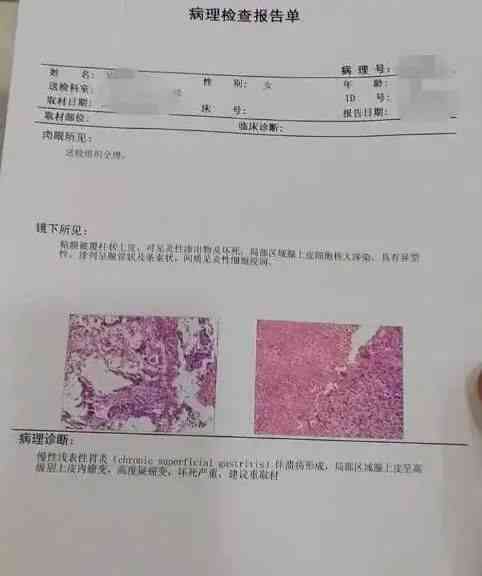 胃镜检查报告ci是什么意思：胃镜结果C1或C-1的含义及原因解析