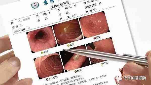 胃镜检查报告ci是什么意思：胃镜结果C1或C-1的含义及原因解析