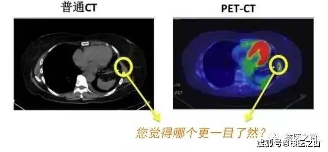 影像学检查：CT报告中的IM征象分析