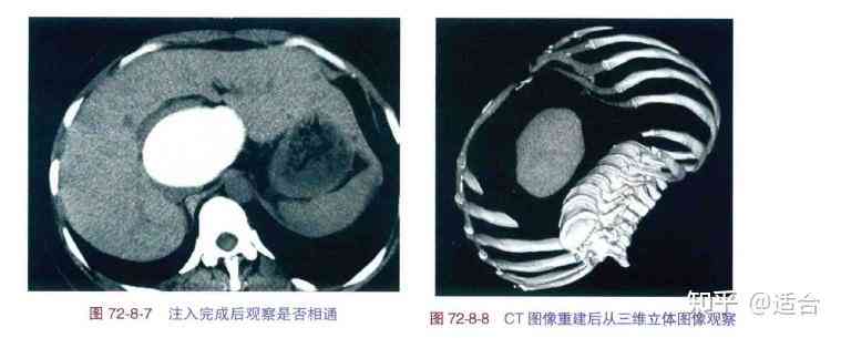 影像学检查：CT报告中的IM征象分析