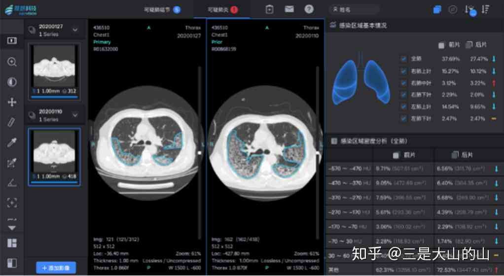 CT报告AI显示是什么意思