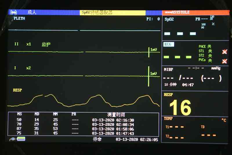 监护机pi：含义、正常值、PVCS解读、功能区别及resp意义解析