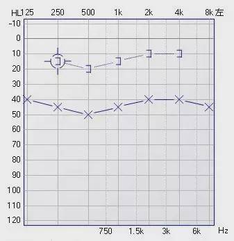 听力报告ai是啥意思：含义及表示解析