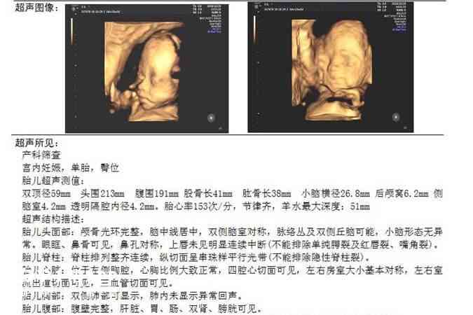 全方位三维彩超数据解析与分析