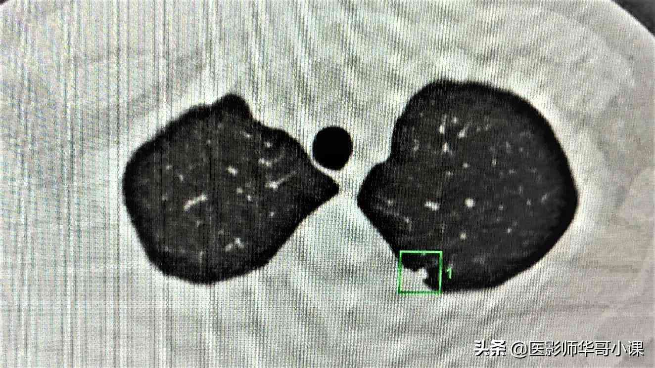 AI医学影像行业报告