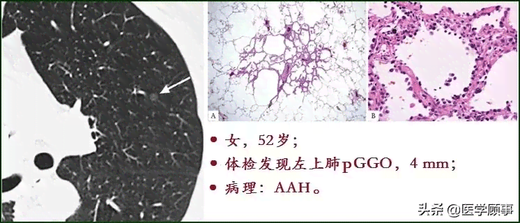 全面解析肺CT报告中的AAH：了解非典型腺瘤样增生的意义与潜在风险