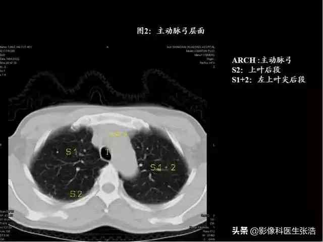 肺ct报告的解读：癌症指标、多条高密度影、英文名称含义及CT值分析