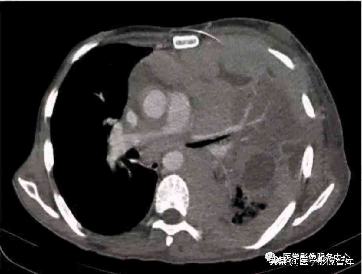 肺部CT报告单术语详解：专业名词解读与常见疾病解析