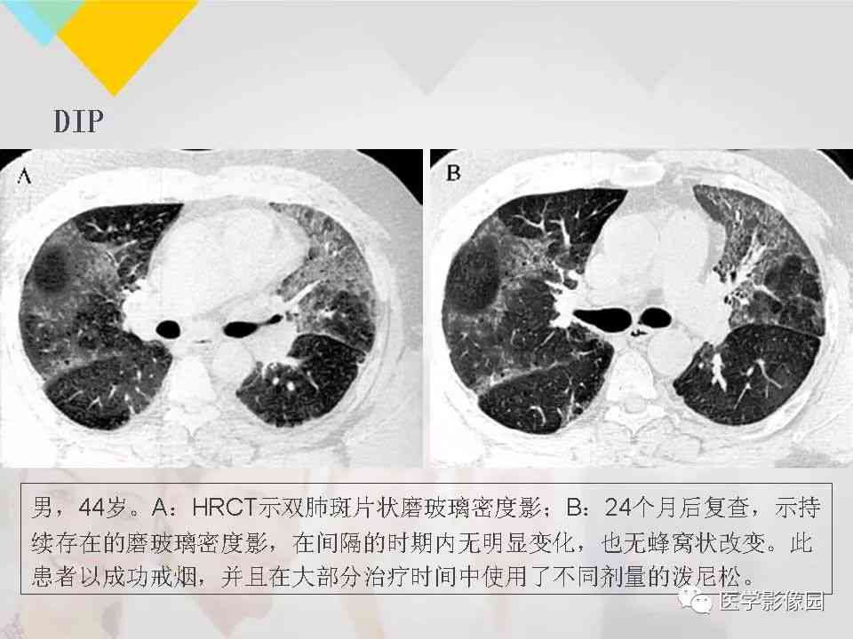 深度解读：肺部CT报告全解析，涵常见病症与潜在健风险