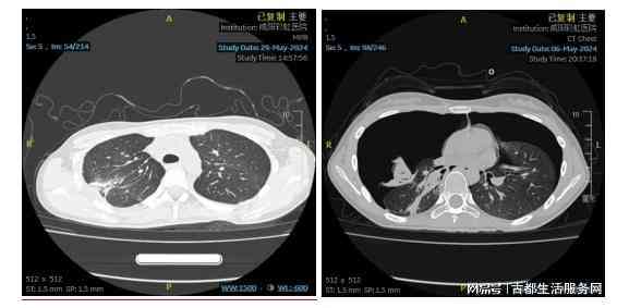 深度解读：肺部CT报告全解析，涵常见病症与潜在健风险