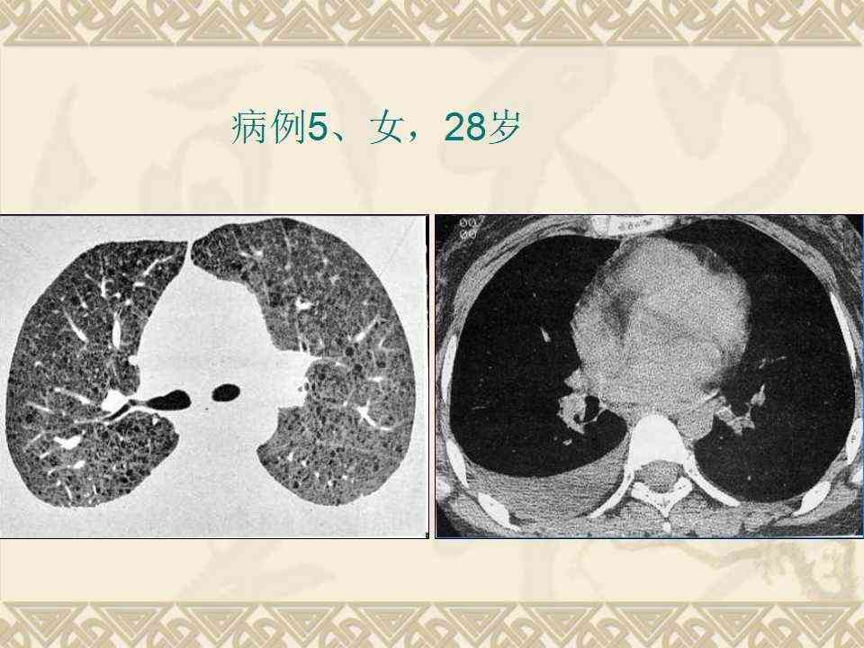 深度解读：肺部CT报告全解析，涵常见病症与潜在健风险