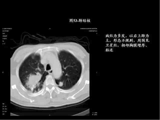 深度解读：肺部CT报告全解析，涵常见病症与潜在健风险