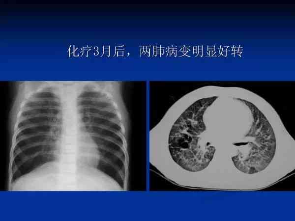 深度解读：肺部CT报告全解析，涵常见病症与潜在健风险