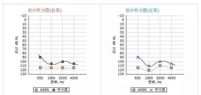 纯音听力测试报告单ai代表什么意思啊：正常值ac解读与结果查看指南