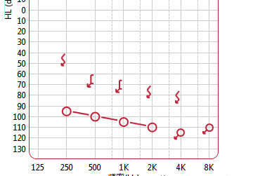 解读纯音听力测试报告：AI辅助解析右耳与耳听力曲线含义