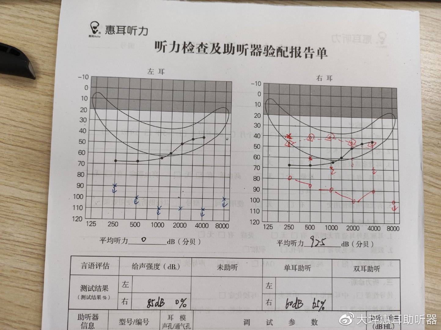 解读纯音听力测试报告：AI辅助解析右耳与耳听力曲线含义