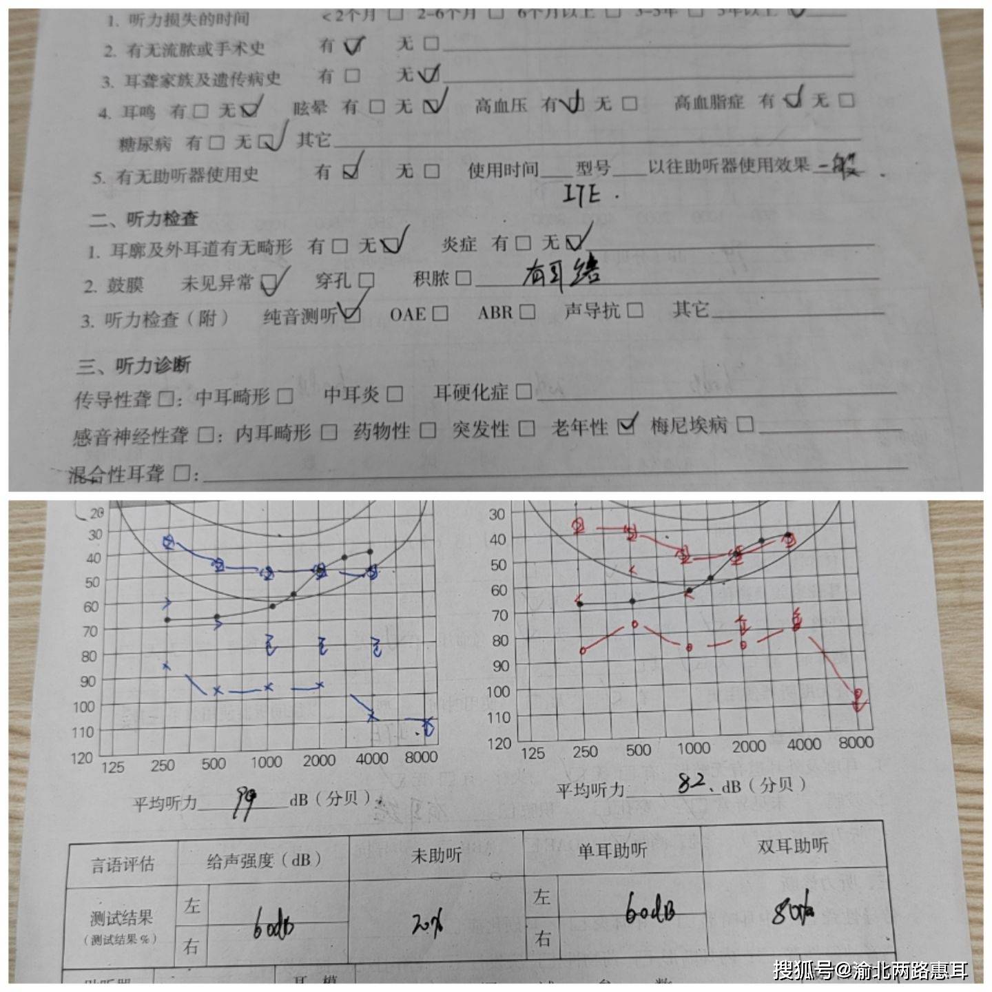 解读纯音听力测试报告：AI辅助解析右耳与耳听力曲线含义