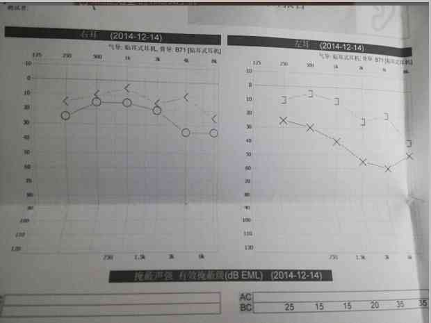 高精度纯音听力评估报告与分析