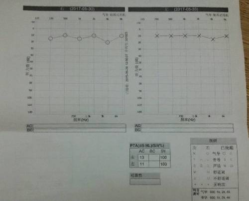 高精度纯音听力评估报告与分析