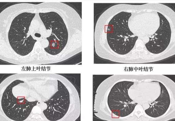 深入解读：AI辅助CT报告中的低危结节含义及患者应对策略