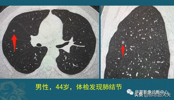 深入解读：AI辅助CT报告中的低危结节含义及患者应对策略