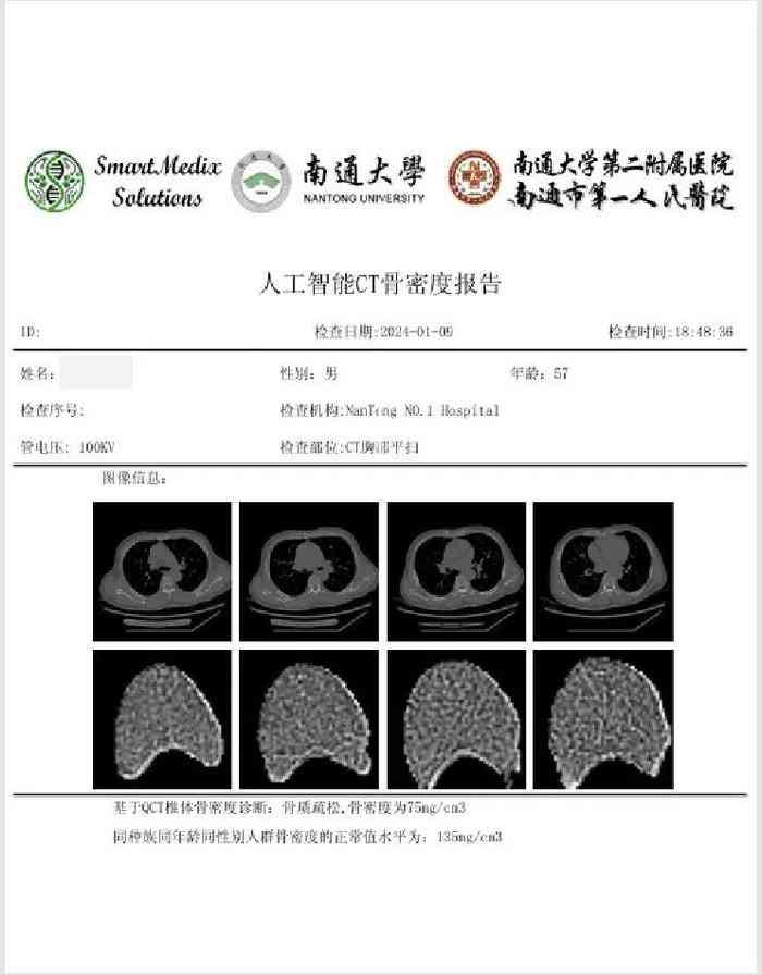 深入解读：AI辅助CT报告中的低危结节含义及患者应对策略