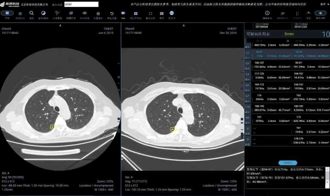 天津胸科医院ai检测报告查询：体检、CT报告官网查询系统及结果