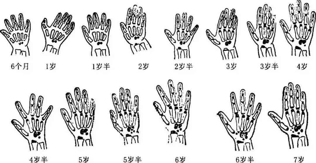 骨龄AI报告准不准怎么看：详解骨龄检测报告单解读方法
